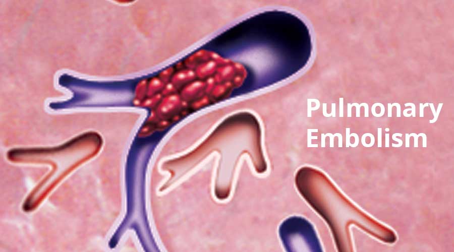 IVC-Filter-Pulmonary-Embolism